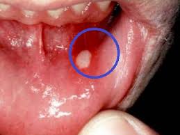oraldiseases