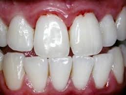 teeth disorder